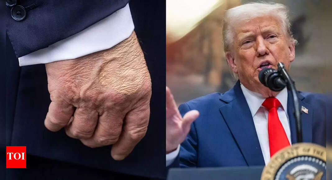 ट्रम्प का स्वास्थ्य नाटक: रहस्यमय हेमेटोमा और सूजन टखने: व्हाइट हाउस क्या नहीं कहता