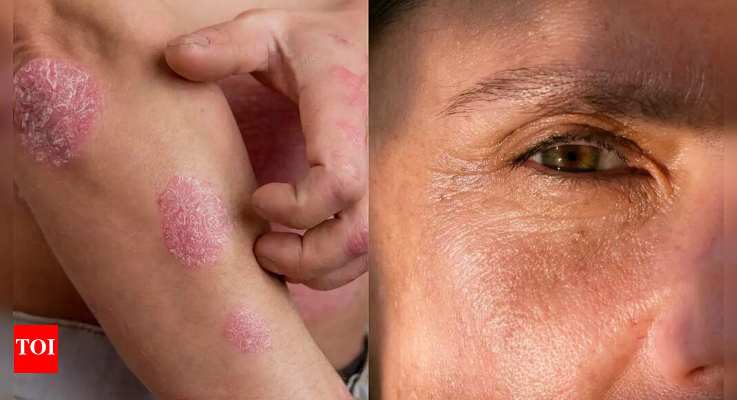 धूम्रपान त्वचा को कैसे प्रभावित करता है: 16 साइड इफेक्ट्स और जोखिम जो पता होना चाहिए |