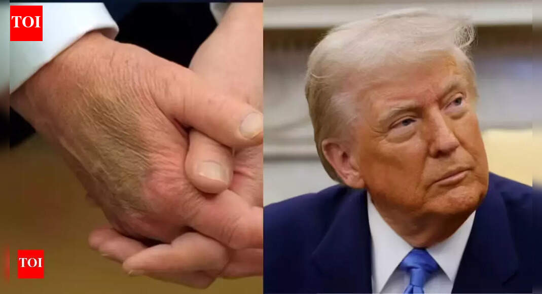 संपीड़न मोज़े, एस्पिरिन और मेकअप: ट्रम्प ने स्वास्थ्य समस्याओं के दृश्य संकेतों को छिपाने की बात स्वीकार की | विश्व समाचार