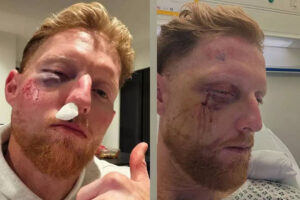 विचित्र नेट्स हिट के बाद बेन स्टोक्स के चेहरे की हुई सर्जरी, इंग्लैंड के कप्तान ने शेयर की फोटो | क्रिकेट समाचार